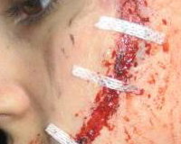 Laceration, Multiple Screwdriver Wounds