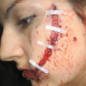 Laceration, Multiple Screwdriver Wounds