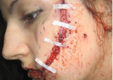 Laceration, Multiple Screwdriver Wounds