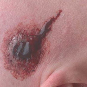 Bullet Wound