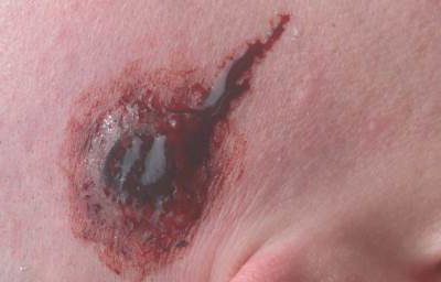 Bullet Wound